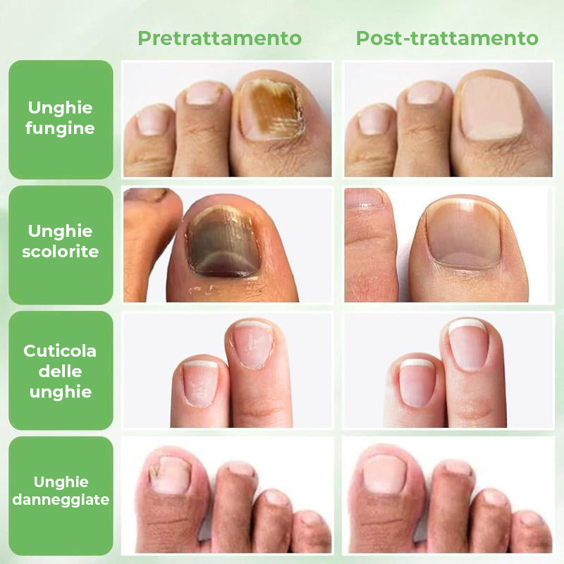 Trattamento unghie allo zenzero